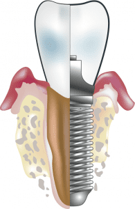 dental-implant-tooth