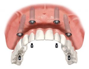 hybrid-denture
