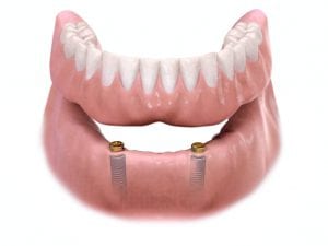 locator-implant-denture