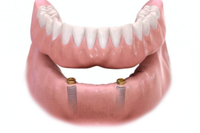 locator-implant-denture