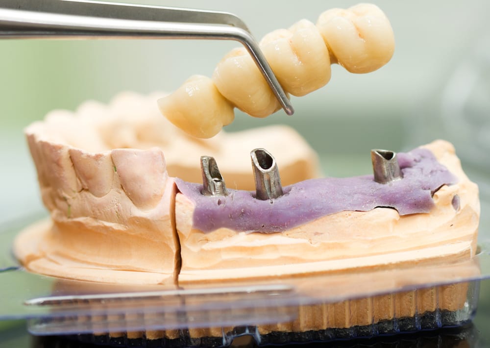 Dental implant head and bridge